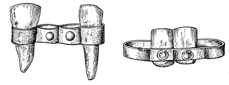 Etruscan prosthetic teeth